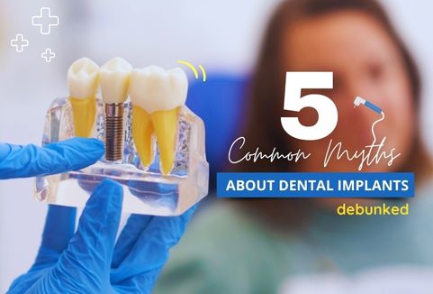 5 Common Myths About Dental Implants Debunked