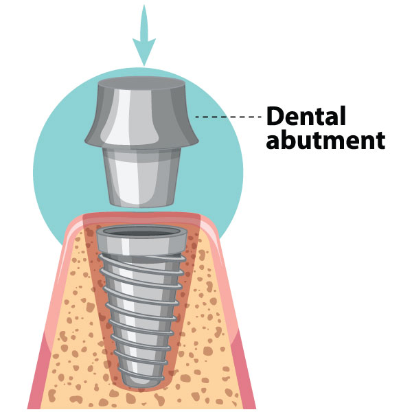 Abutment is placed on the top of dental implant which has now settled with the jawbone. It is used to place the crown