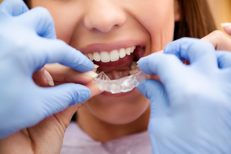 Dental Braces: Advantages of Invisalign