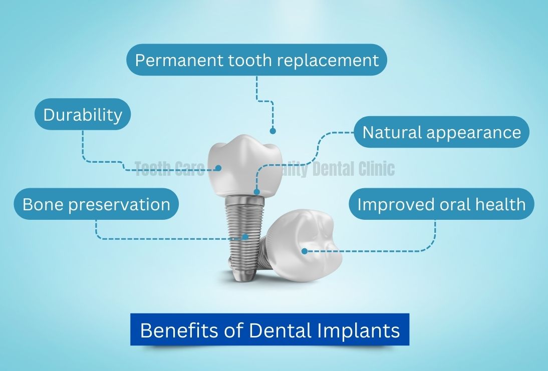 Benefits of Dental Implants