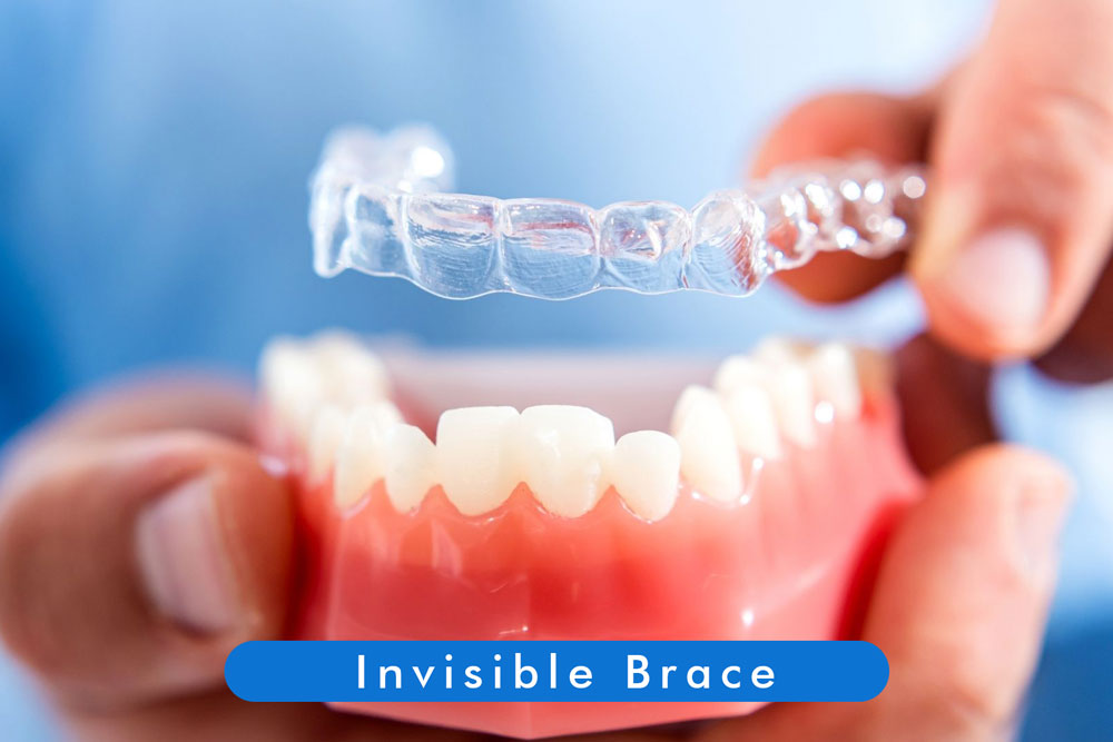 Invisible Braces or Clear Aligners in kolkata