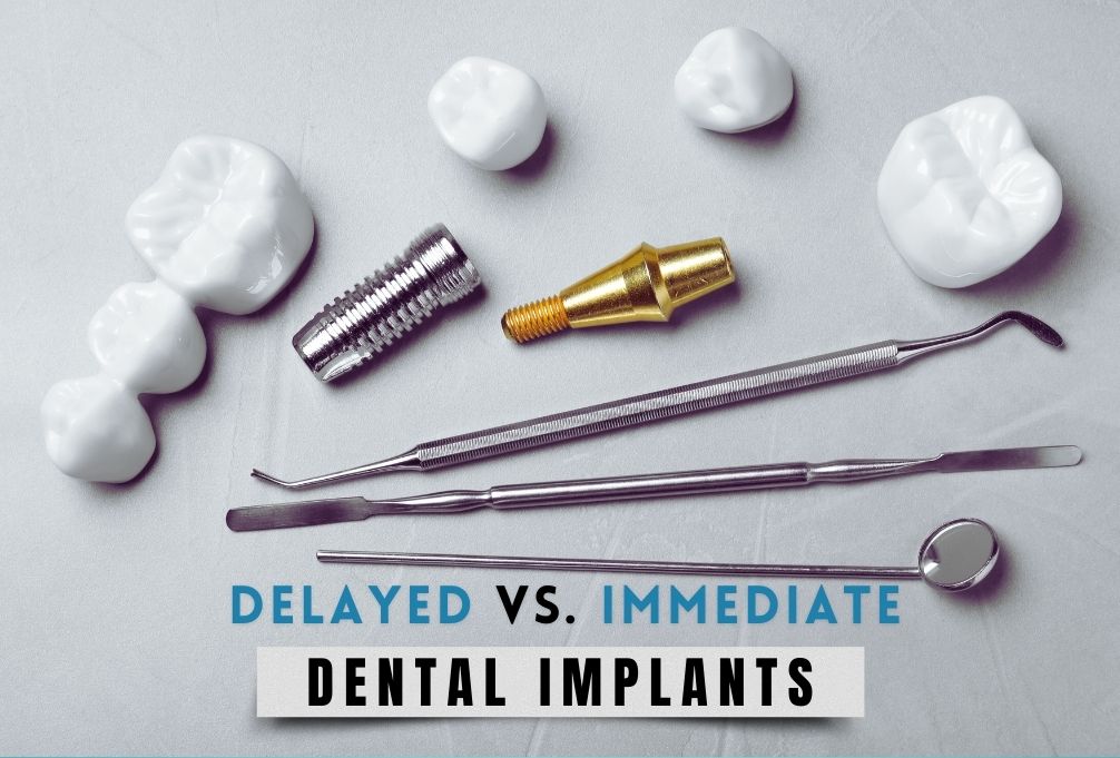 Quick Guide: Delayed vs. Immediate Dental Implants