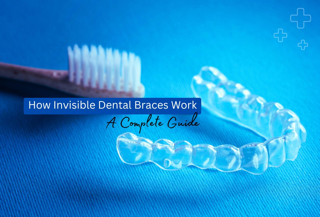 How Invisible Dental Braces Work: A Complete Guide