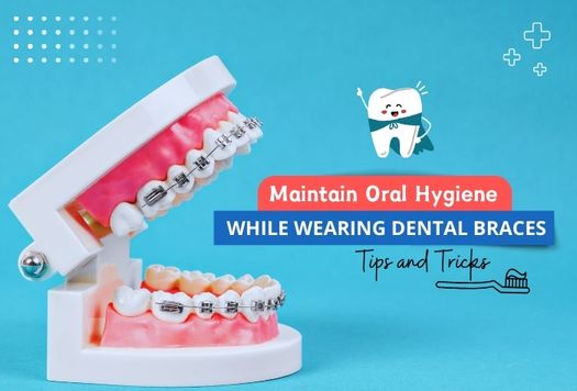How to Maintain Oral Hygiene While Wearing Dental Braces: Tips and Tricks