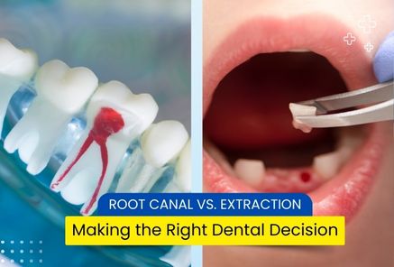 Root Canal vs. Extraction: Making the Right Dental Decision