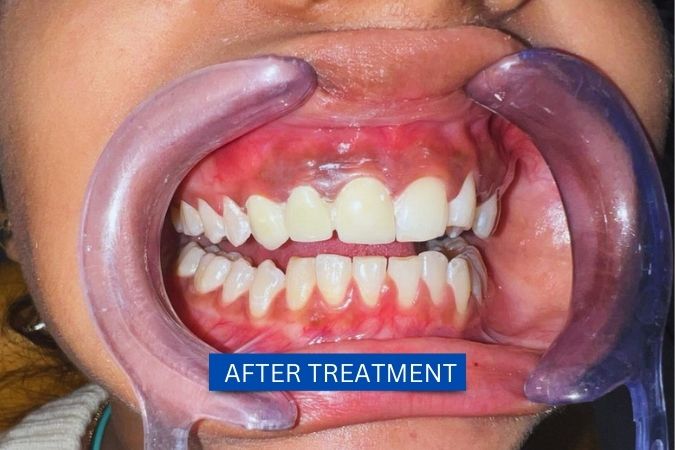 Shakshi after dental implants treatment