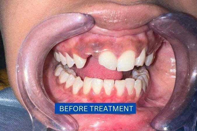 Shakshi before dental implants treatment