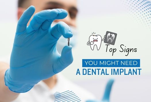 Top Signs You Might Need a Dental Implant