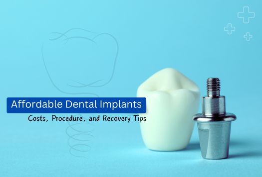 Affordable Dental Implants: Costs, Procedure, and Recovery Tips