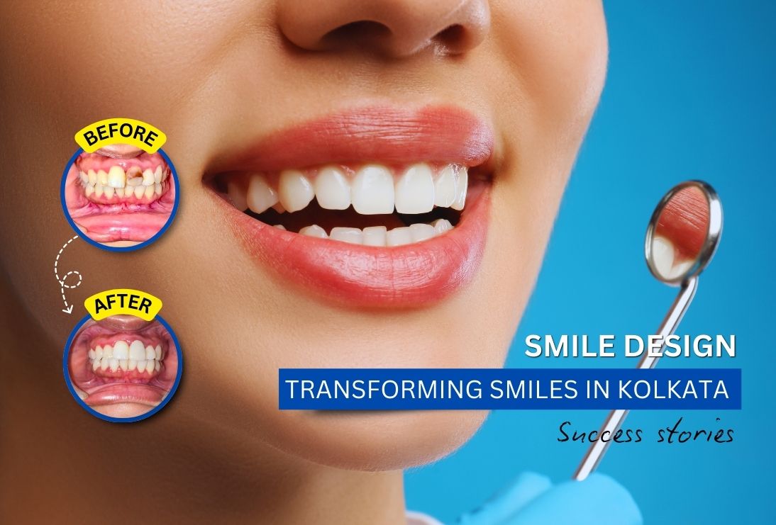 Smile Design: Transforming Smiles in Kolkata - Success Stories