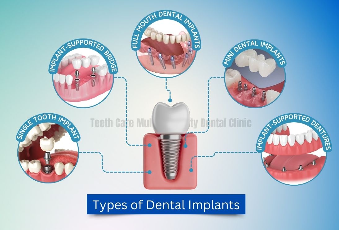 Types of Dental Implants