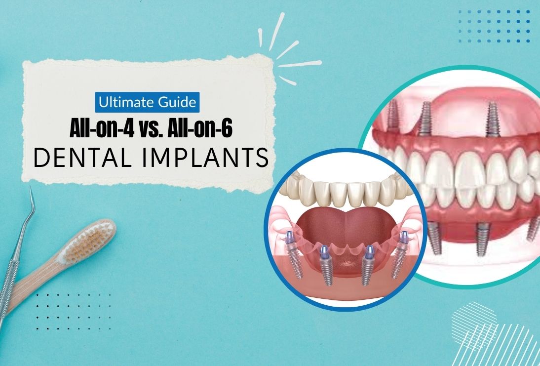 Ultimate Guide to All-on-4 vs. All-on-6 Dental Implants