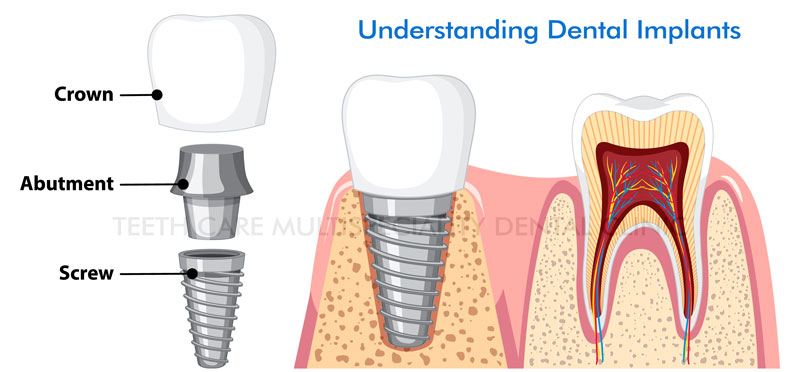 Is a dental implant painful?