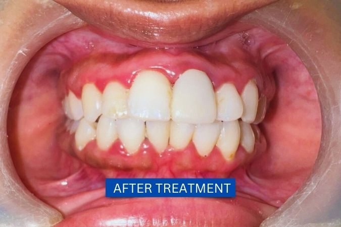 Vanshika after teeth whitening and porcelain veneers treatment.