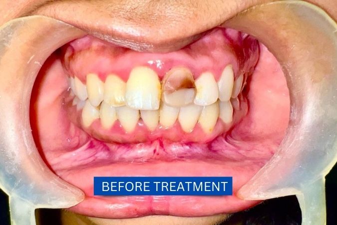 Vanshika before teeth whitening and porcelain veneers treatment