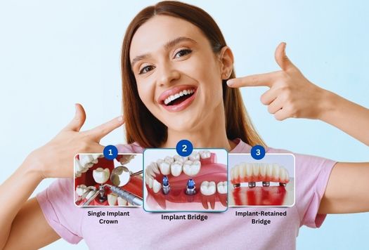 What Are the 3 Types of Dental Implants?