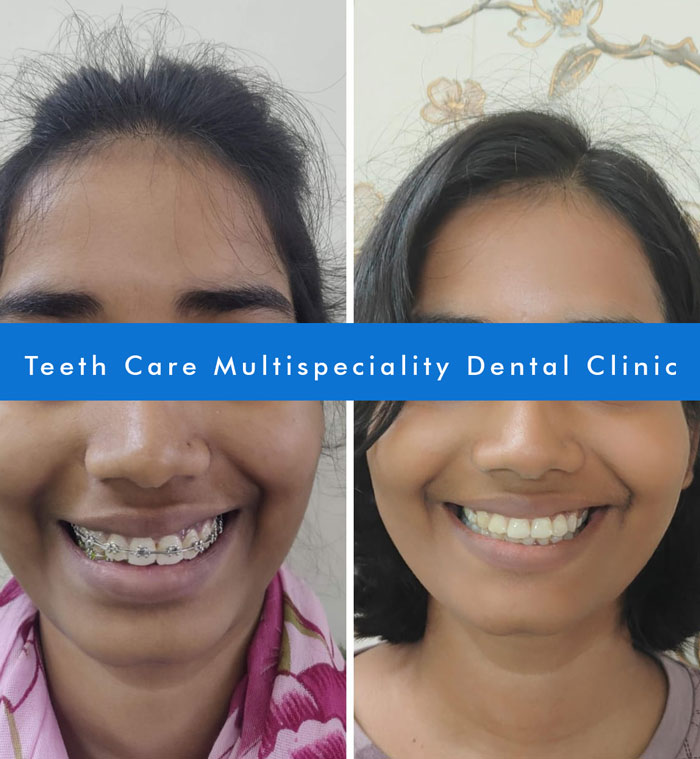 Dental Braces in kolkata