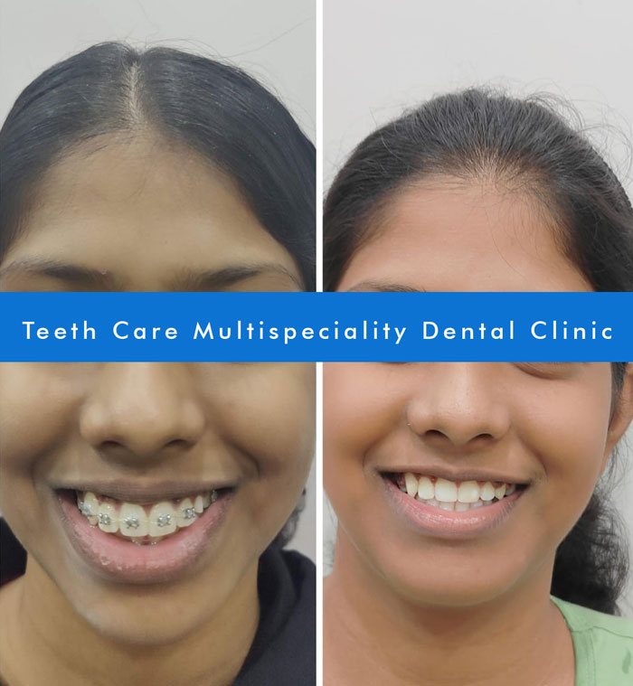 Dental Braces in kolkata