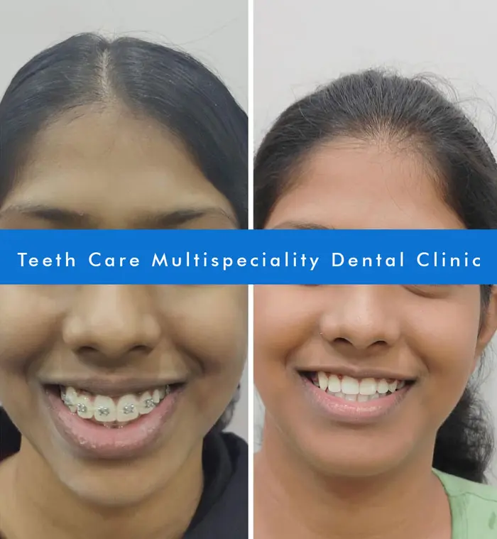 Metal Braces Before After Transformation Kolkata Patient 2