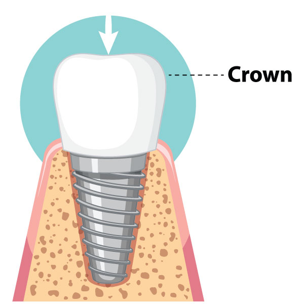CAD/CAM Crown is placed on the abutment to make the implant like real tooth. The crown acts like the original tooth