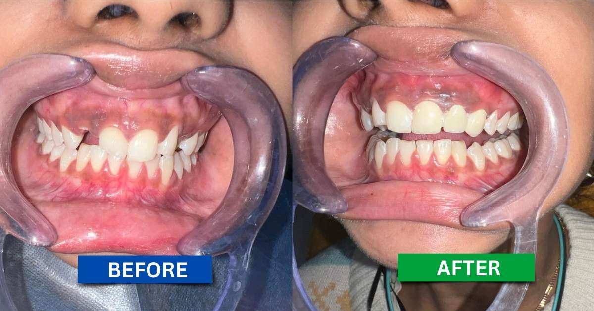 A female teeth after dental implant in kolkata 