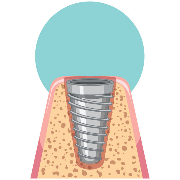 During healing period after the dental implants placement, the jaw bone is allowed to recover and grow around the screw