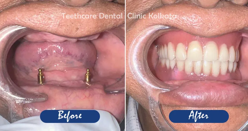 Full Mouth Dental Implants in kolkata