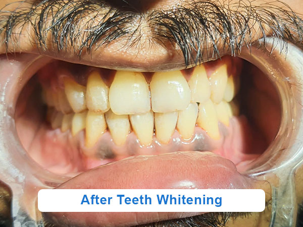 After teeth whitening