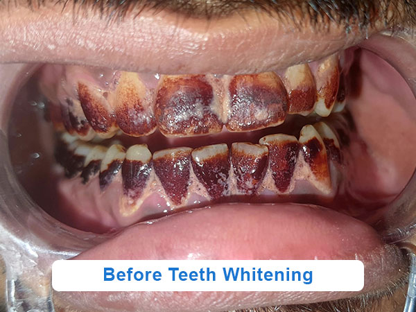 before teeth whitening