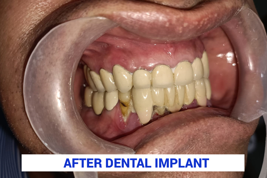 Dental Implant After 
