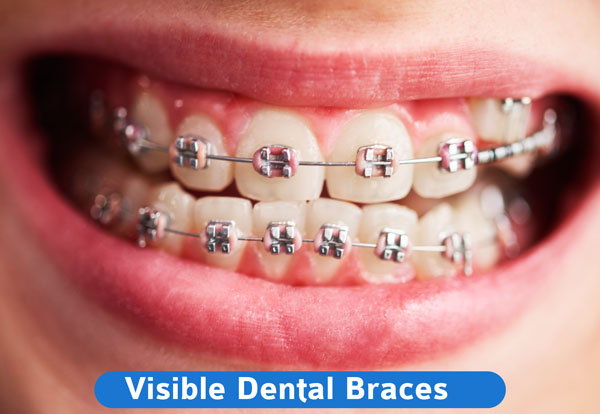 visible Dental Braces to straighten your teeth