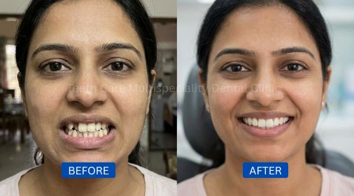 Smile transformation using invisible dental braces in Kolkata demonstrating effective alignment of teeth with clear aligners. Ideal for patients looking for a modern, nearly invisible orthodontic treatment for a confident and natural-looking smile.