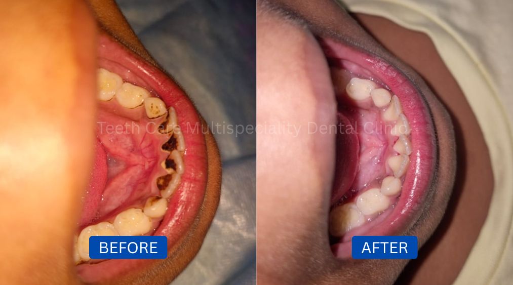 Before and after results of professional Teeth Scaling in Kolkata showing removal of plaque, tartar, and stains at Teeth Care Multispeciality Dental Clinic.