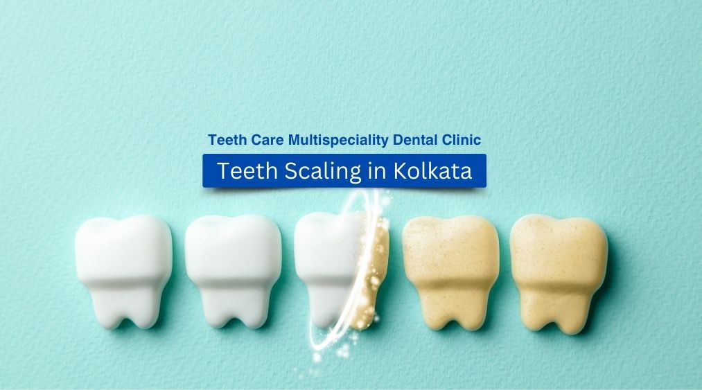 Illustration showing Teeth Scaling in Kolkata procedure with plaque and tartar removal from teeth for improved oral hygiene.