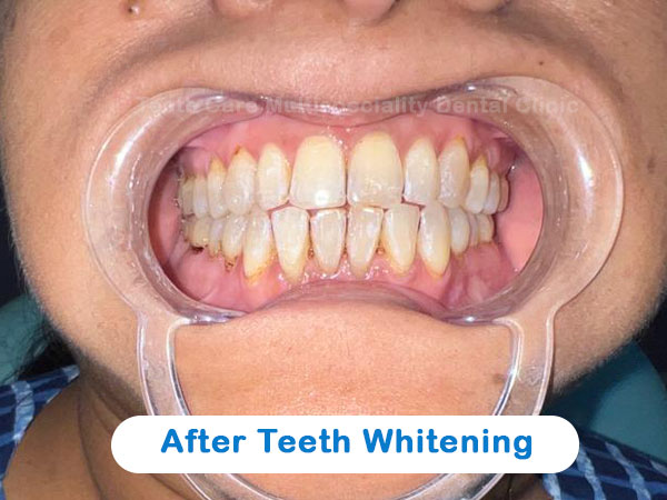 After laser teeth whitening