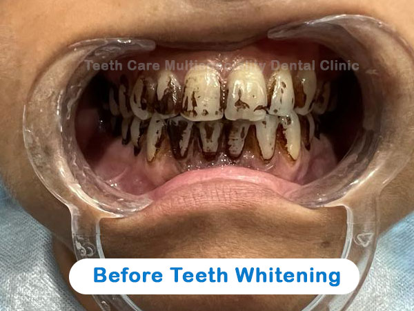 before laser teeth whitening