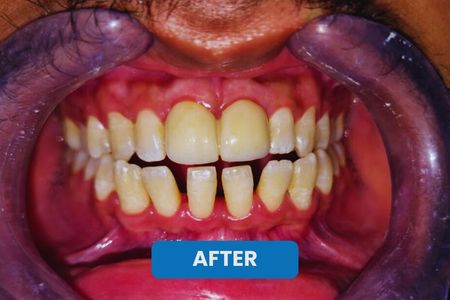 after Zirconia Dental Crown in kolkata 