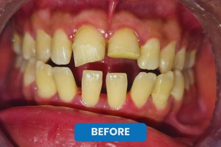 before Zirconia Dental Crown in kolkata